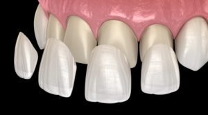 veneer installation procedure 3D illustration 